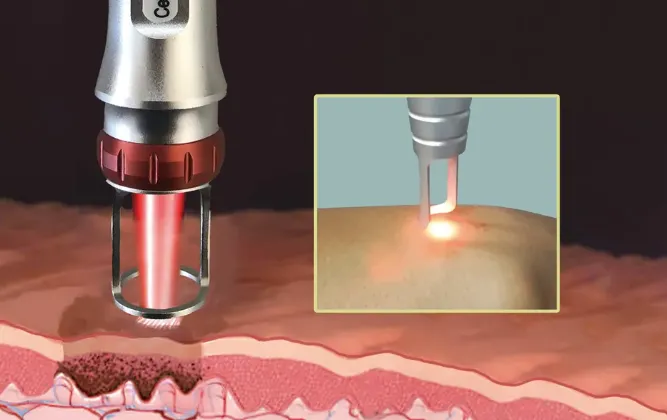 What Does the ND:YAG Laser Do in Cosmetic Dermatology?